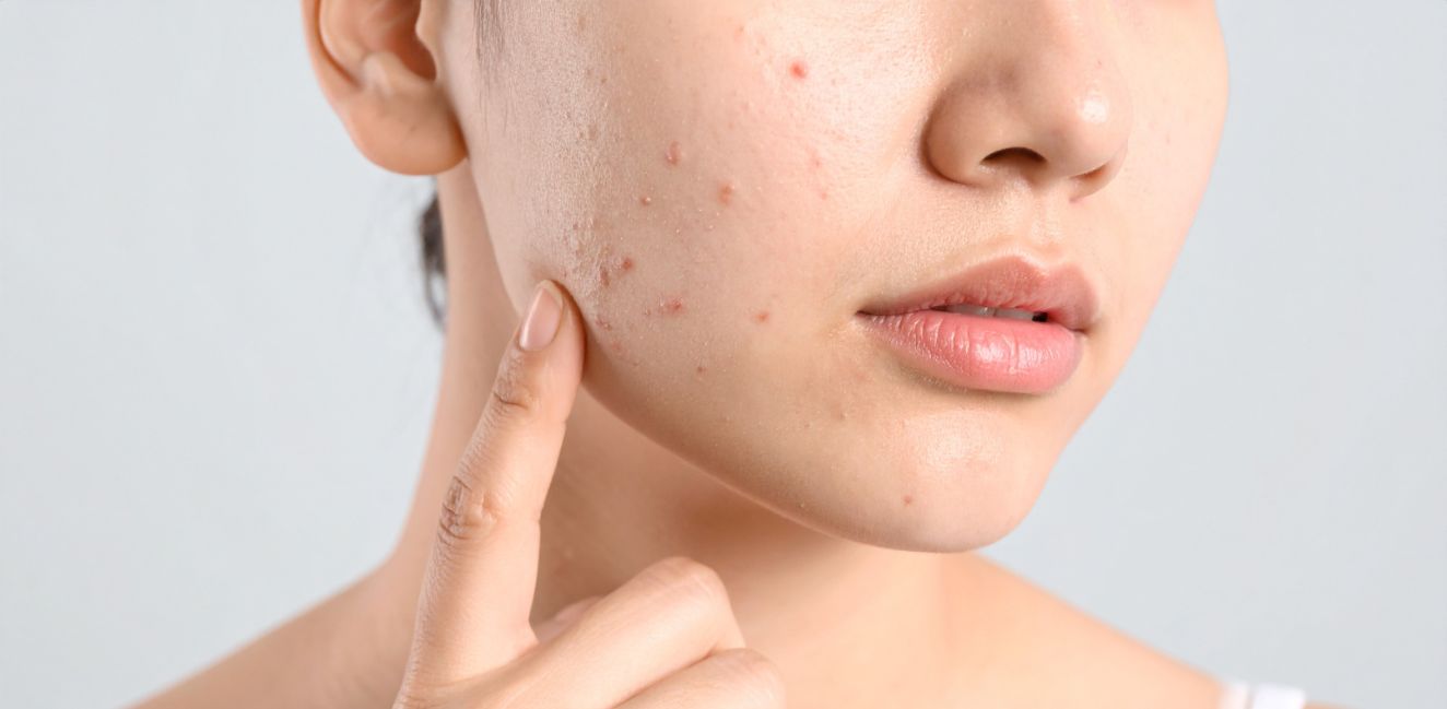 Holistic Homeopathic Skin Care Treatment for Perfect Skin Health
