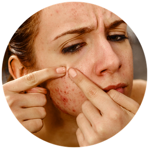 Acne Control