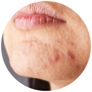 Reduces Breakouts
