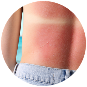 Prevents Tanning