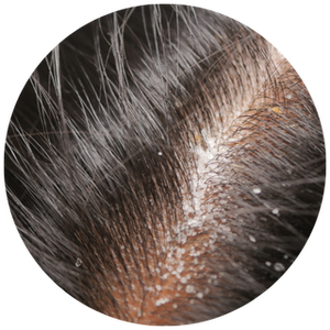 Scalp Oil & Buildup