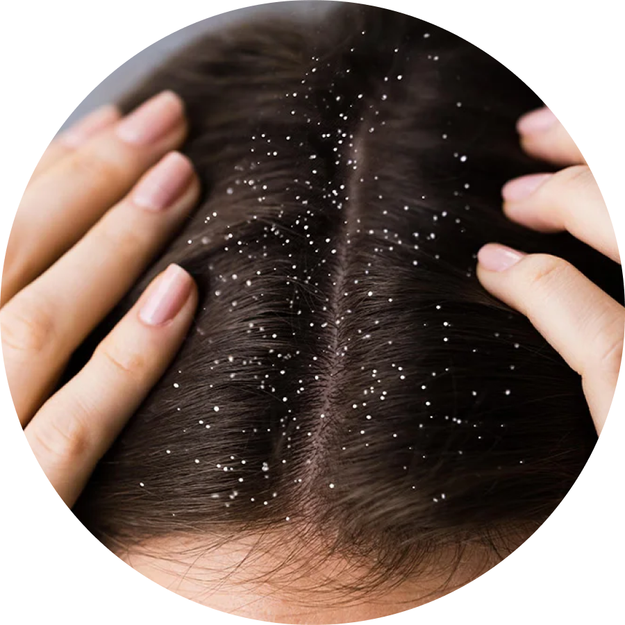Dandruff Isn’t Dryness. It’s a Scalp Disorder