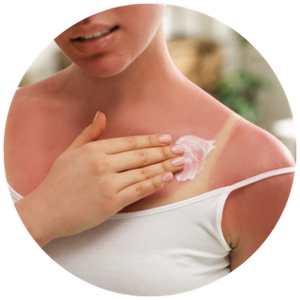 Sunburn Care
